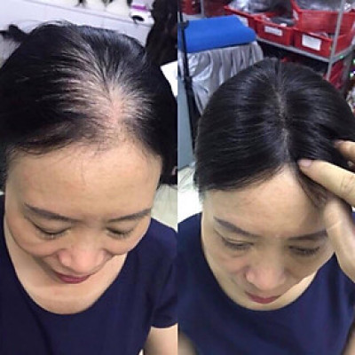 Tóc giả che mái hói️ tóc đỉnh đầu có da đầu