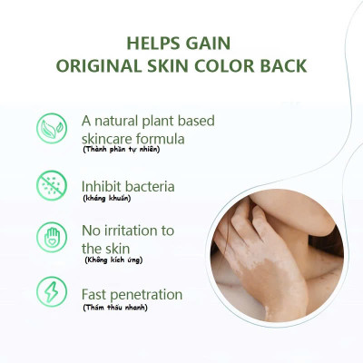 [Vilitigo] Chiết xuất thảo dược, Kem bôi lang ben, hắc lào, nấm ngứa, á sừng, vẩy nến loại tốt an toàn hiệu quả