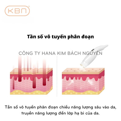 Máy Nâng Cơ POLKA RF Hàn Quốc Xóa Nhăn, Trẻ Hóa Da