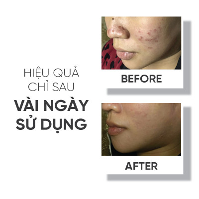 Serum giúp ngăn ngừa mụn, giảm nhờn cho da, giảm mờ vết thâm mụn Lá House Acne Control 15ml/30ml