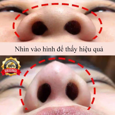 Tinh Dầu Nâng Mũi Tạo Hình Tự Nhiên – Nâng Sống Mũi Thẳng Đẹp Hiệu Quả Tại Nhà