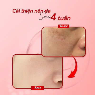 Kem Dưỡng Trắng Da Mờ Thâm Nám Sâm Nhung Hoàng Kim Cao Cấp Melasma Cream Nano White MISS CANDY 25g, Giúp Tái Tạo Da Bị Nhiễm Corticoid, Phục Hồi Làn Da Hư Tổn & Làm Săn Chắc Da