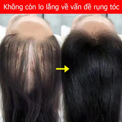 Tinh Dầu Xịt Mọc Tóc EELHOE: Tinh Chất Thiên Nhiên Từ Nhân Sâm Giup Mọc Tóc Hiệu Quả Chỉ Sau 7 Ngày