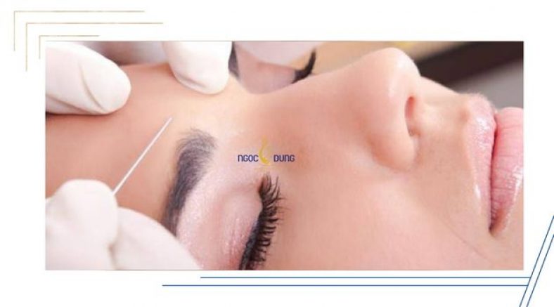 Sự thật treo chân mày nội soi có đau