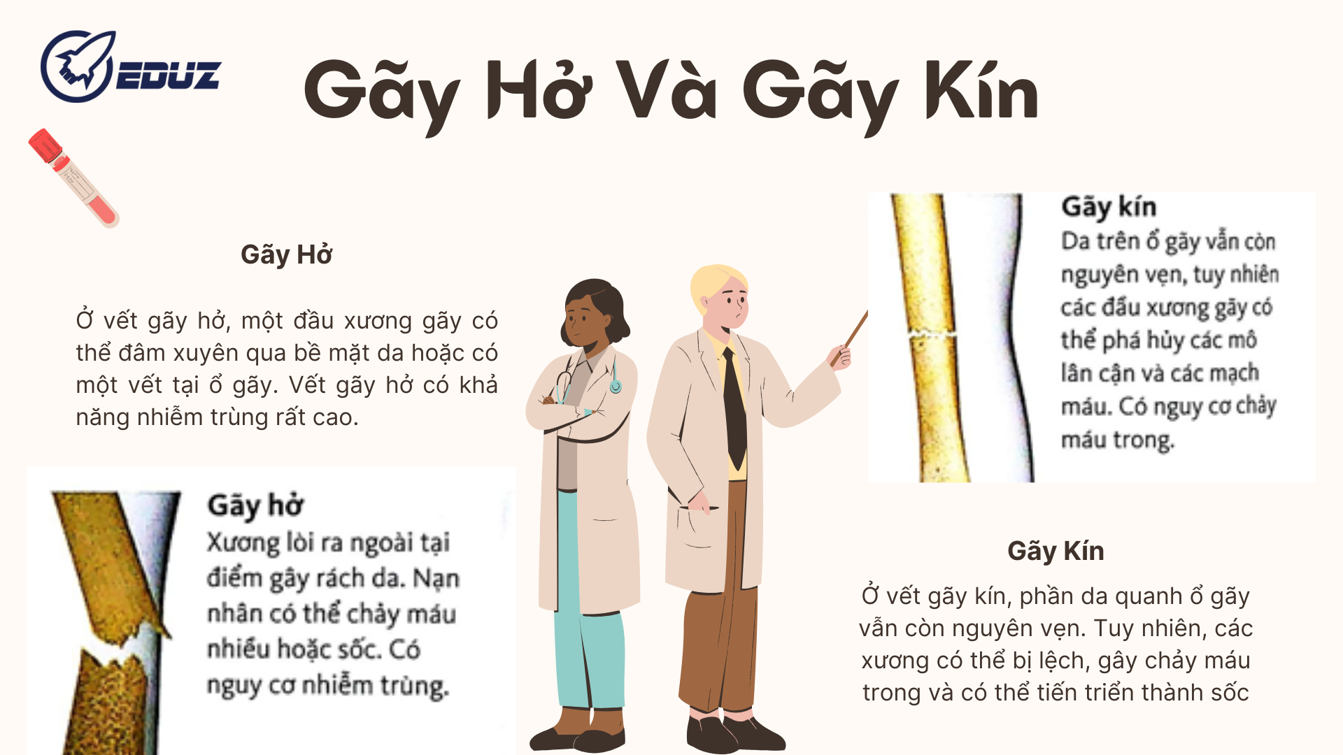 4. Gãy hở và gãy kín