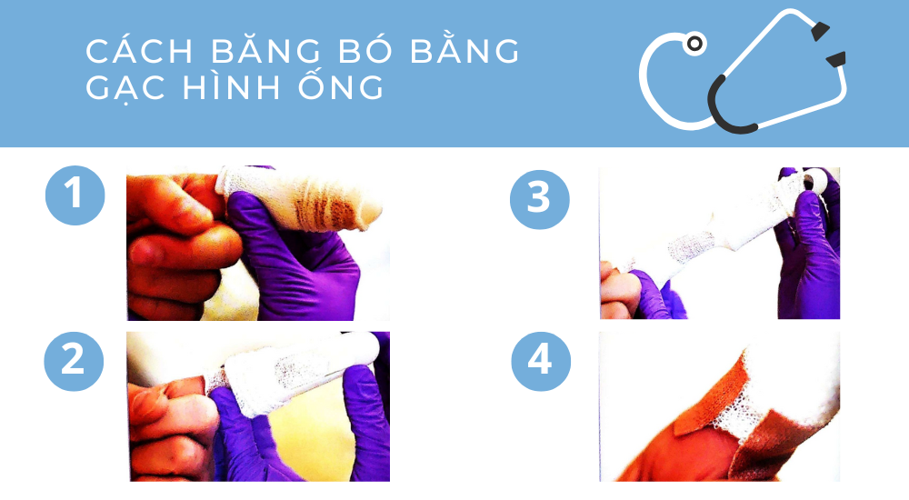 1.1. Cách băng bó bằng gạc hình ống: