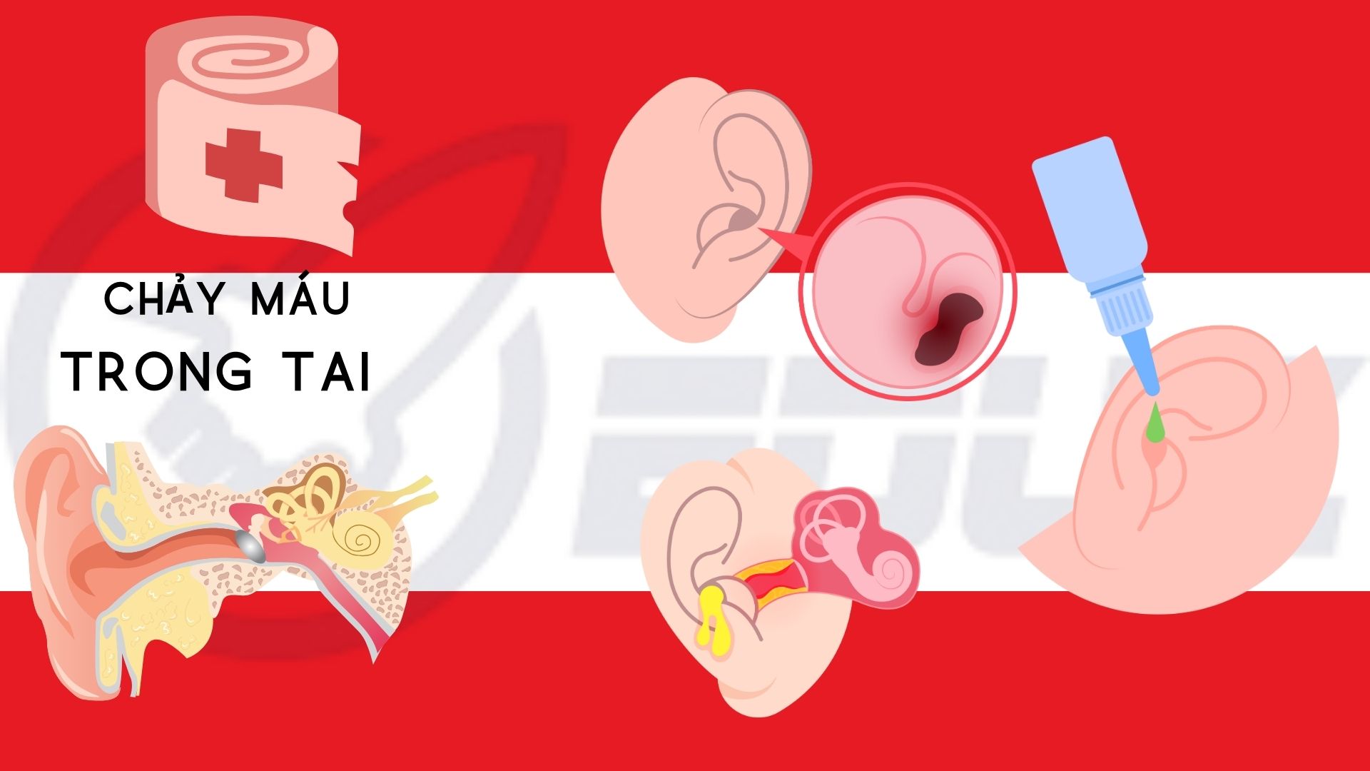 Chảy máu trong tai