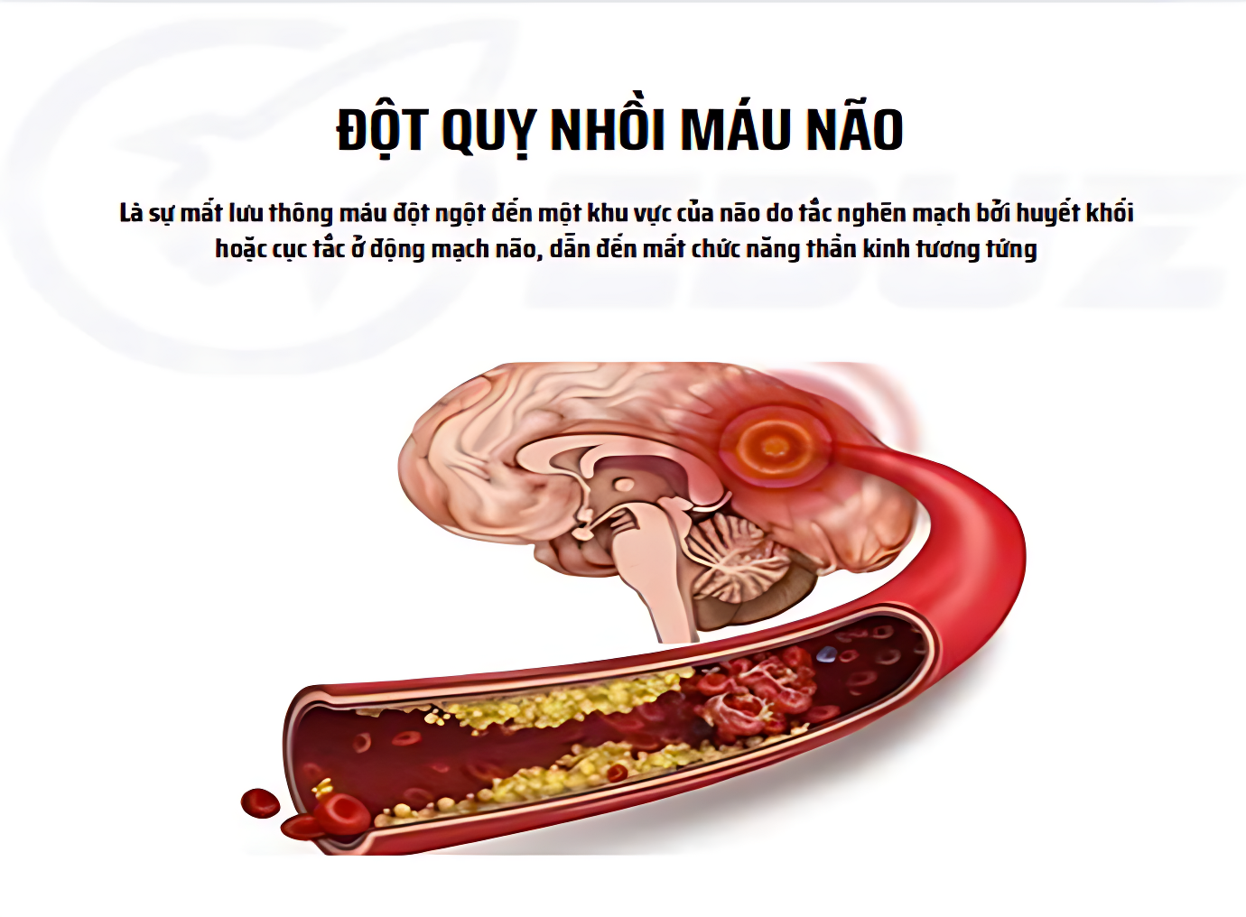 ĐỘT QUỴ NHỒI MÁU NÃO (đột quỵ thiếu máu não)
