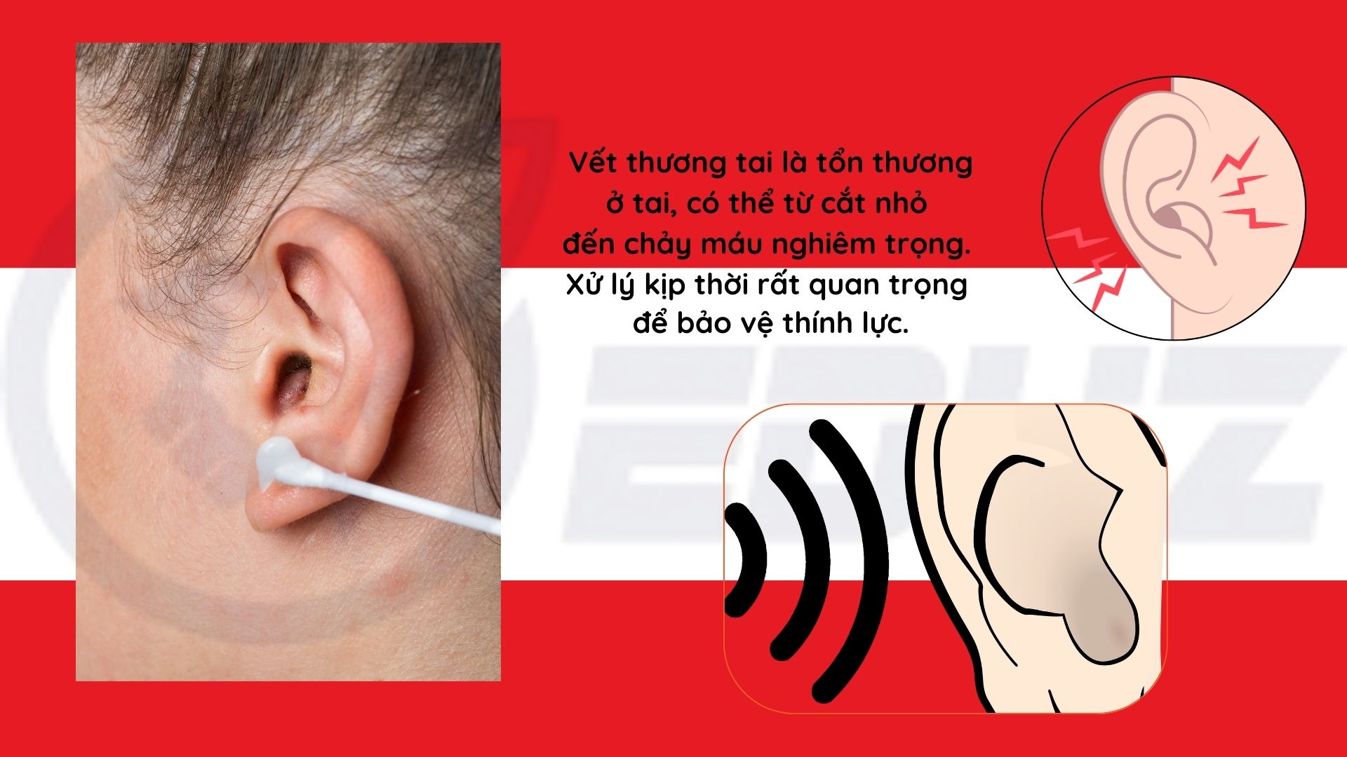 1.Vết thương tai là gì?