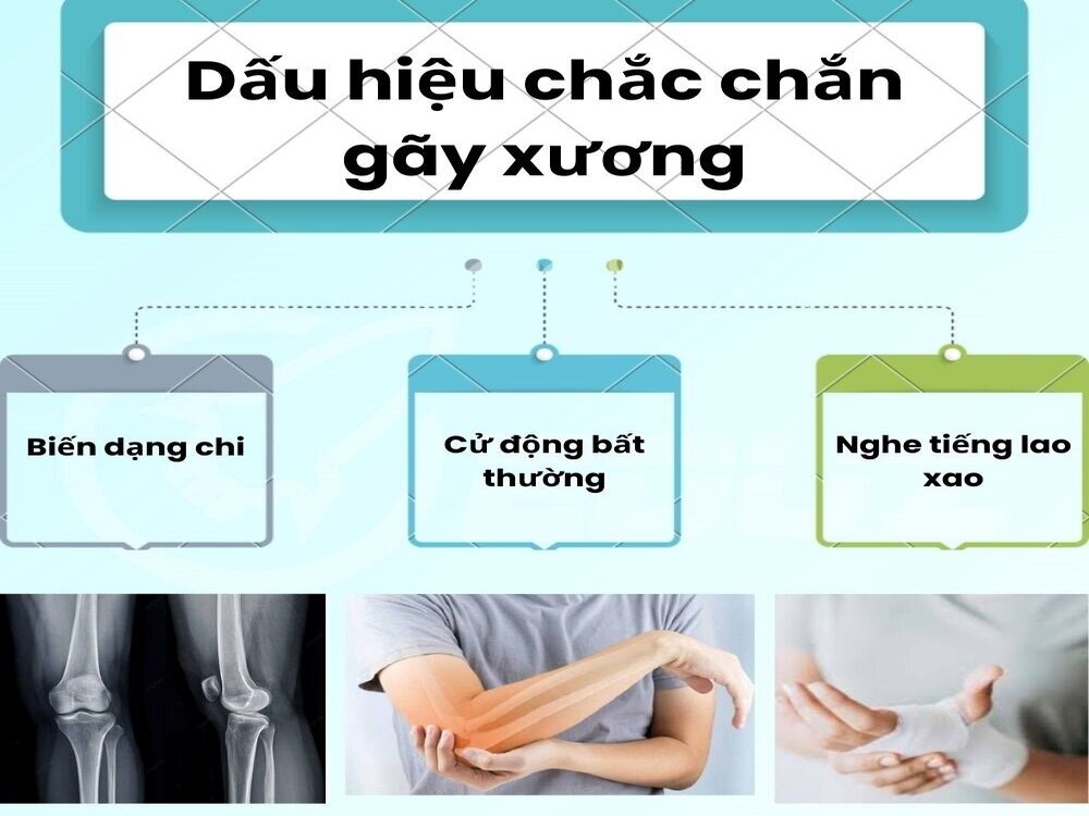 2. Dấu hiệu chắc chắn gãy xương